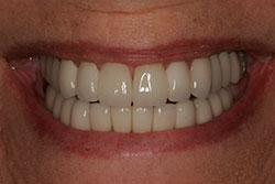Crowns After Photo