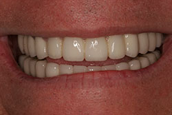 Implant Reconstruction After Photo
