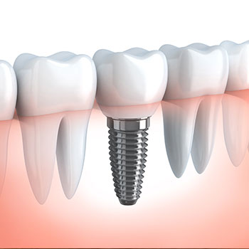 Dental Implants in Jupiter, FL