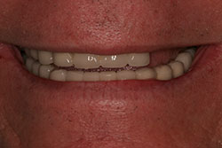 Implant Reconstruction Before Photo