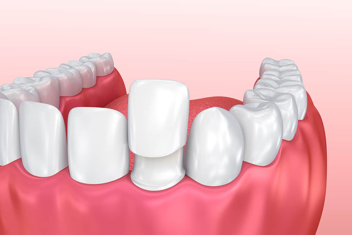 Can veneers fix gaps and uneven teeth without orthodontics blog