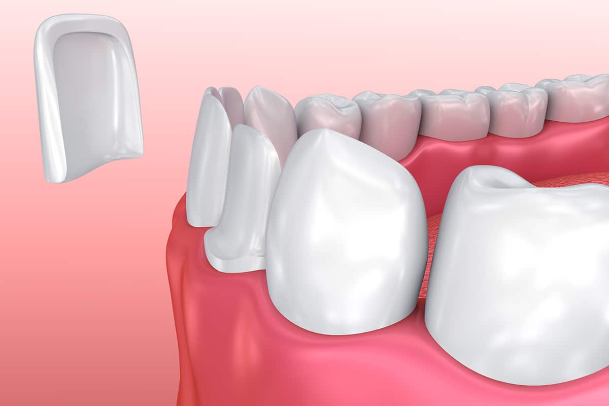 Dental bonding vs veneers for chipped teeth cost durability and results blog