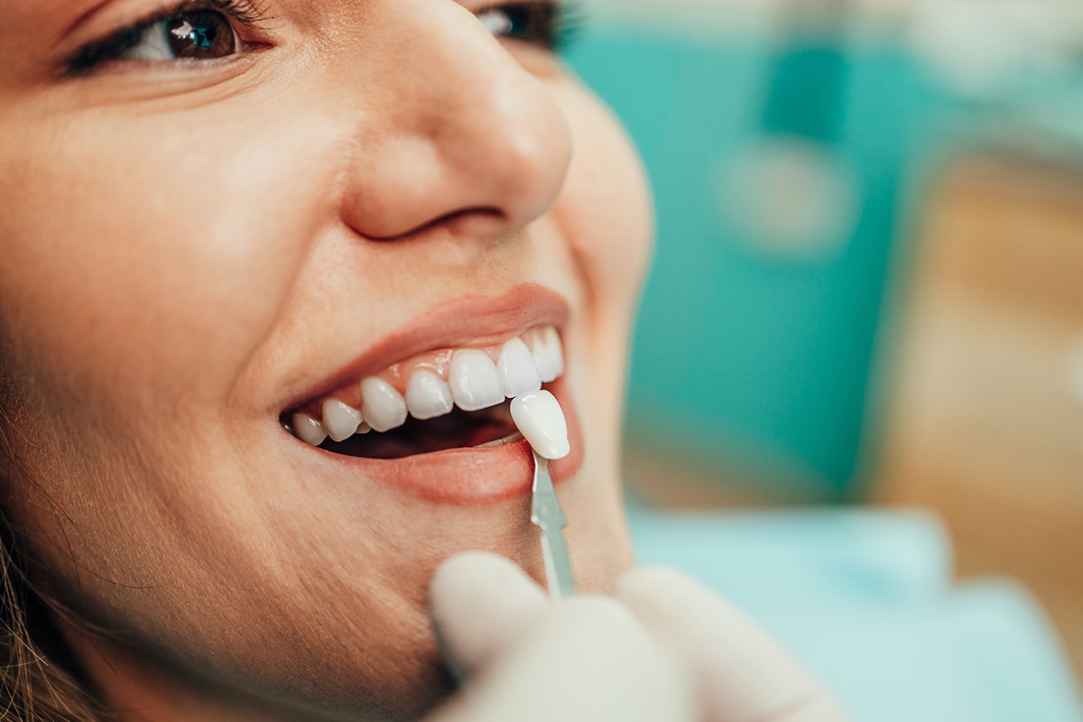 How many veneers do you really need for a smile makeover blog